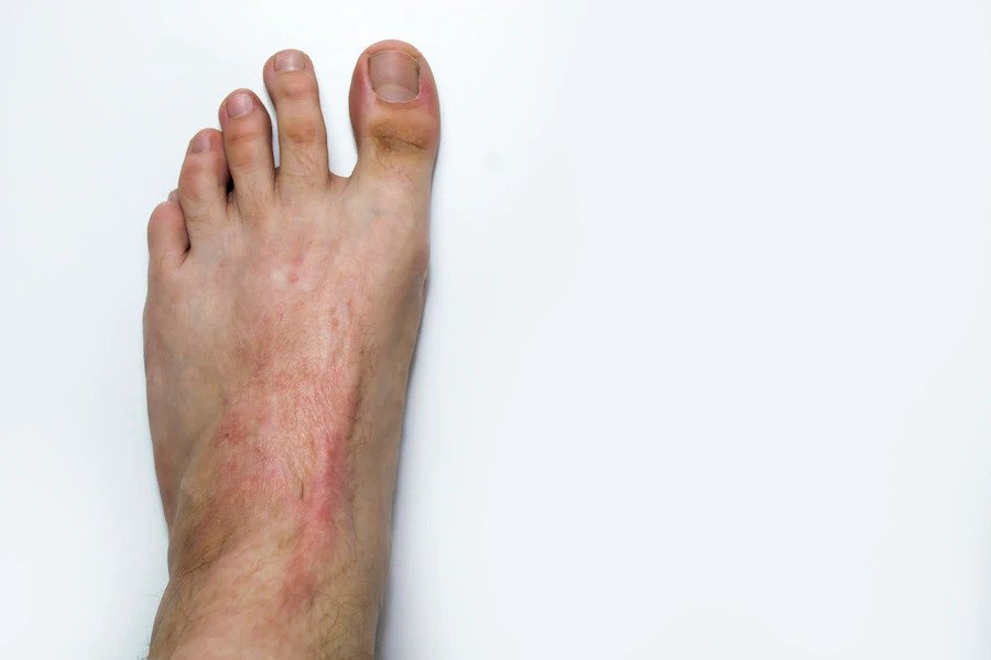 scar in feet healed